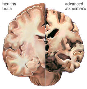 Eiwitplaques, een belangrijke oorzaak van alzheimer verbonden met fijnstof, metaaldeeltjes, teken en vlees